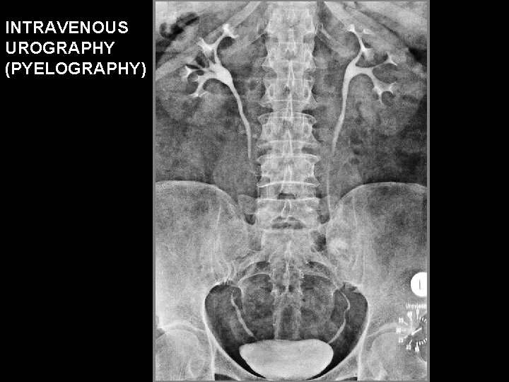 INTRAVENOUS UROGRAPHY (PYELOGRAPHY) 