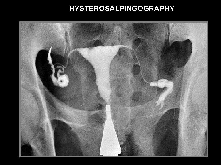 HYSTEROSALPINGOGRAPHY 