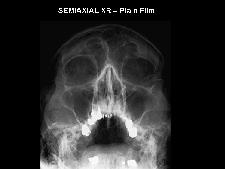 SEMIAXIAL XR – Plain Film 