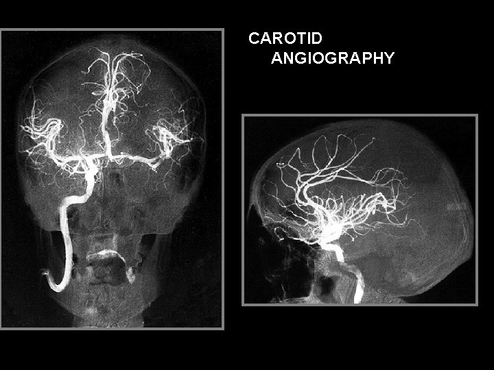 CAROTID ANGIOGRAPHY 