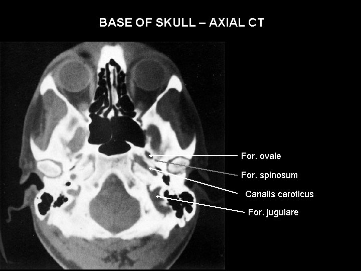 BASE OF SKULL – AXIAL CT For. ovale For. spinosum Canalis caroticus For. jugulare