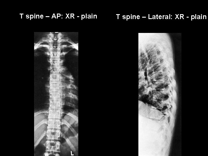 T spine – AP: XR - plain T spine – Lateral: XR - plain