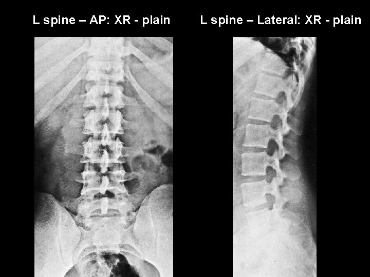 L spine – AP: XR - plain L spine – Lateral: XR - plain