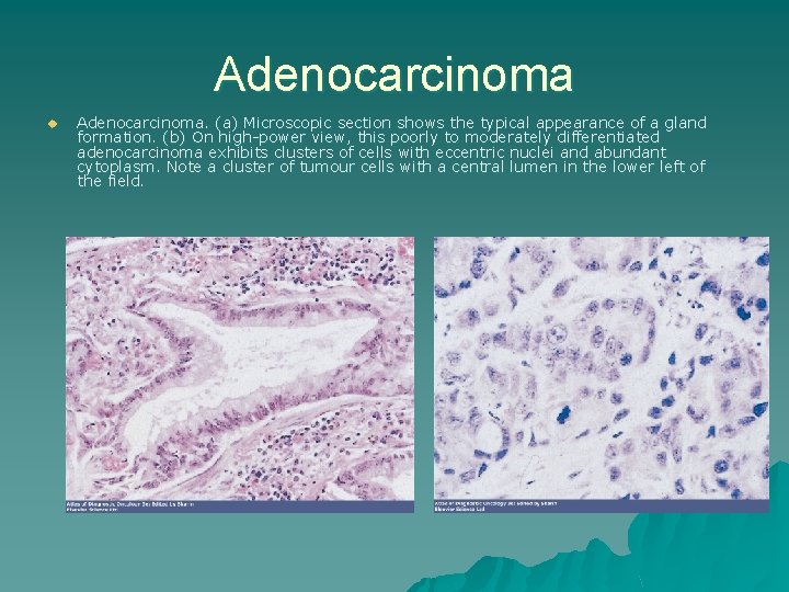 Adenocarcinoma u Adenocarcinoma. (a) Microscopic section shows the typical appearance of a gland formation.