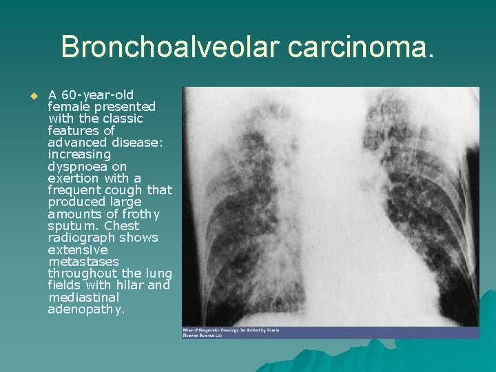 Bronchoalveolar carcinoma. u A 60 -year-old female presented with the classic features of advanced