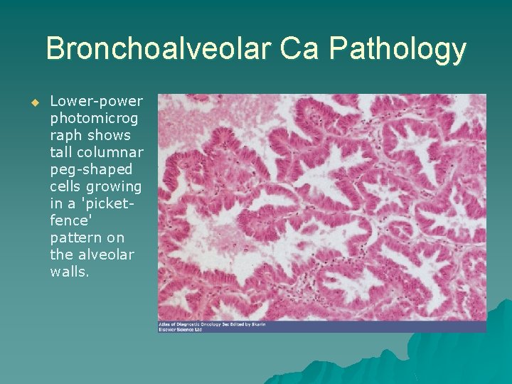 Bronchoalveolar Ca Pathology u Lower-power photomicrog raph shows tall columnar peg-shaped cells growing in