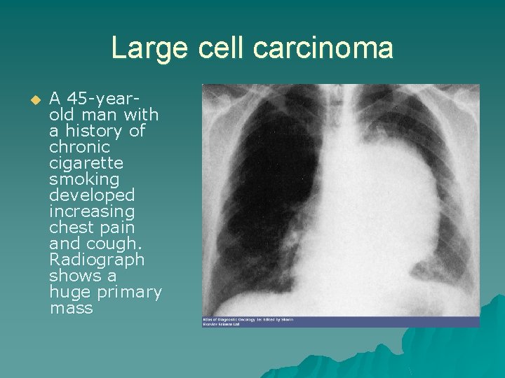 Large cell carcinoma u A 45 -yearold man with a history of chronic cigarette