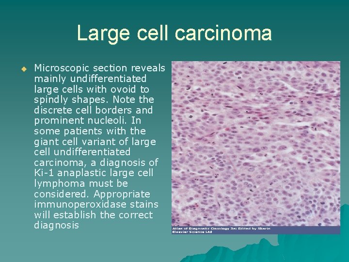 Large cell carcinoma u Microscopic section reveals mainly undifferentiated large cells with ovoid to