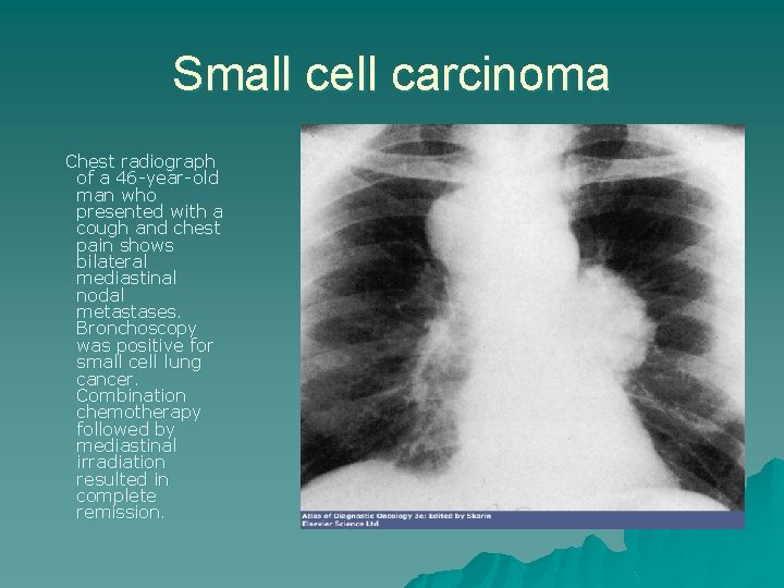 Small cell carcinoma Chest radiograph of a 46 -year-old man who presented with a