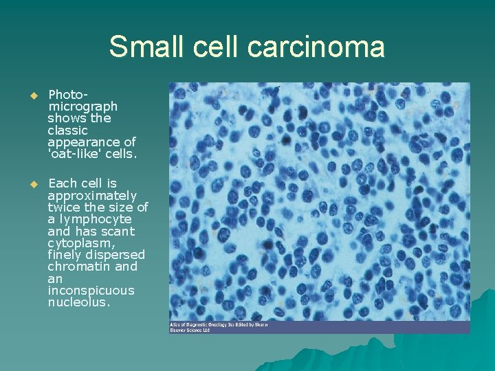 Small cell carcinoma u Photomicrograph shows the classic appearance of 'oat-like' cells. u Each