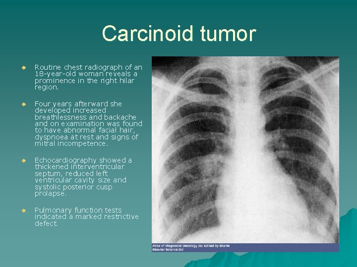Carcinoid tumor u Routine chest radiograph of an 18 -year-old woman reveals a prominence