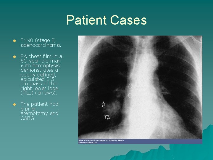 Patient Cases u T 1 N 0 (stage I) adenocarcinoma. u PA chest film
