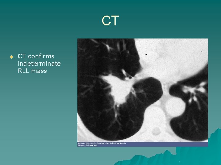 CT u CT confirms indeterminate RLL mass 