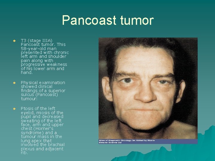 Pancoast tumor u T 3 (stage IIIA) Pancoast tumor. This 58 -year-old man presented