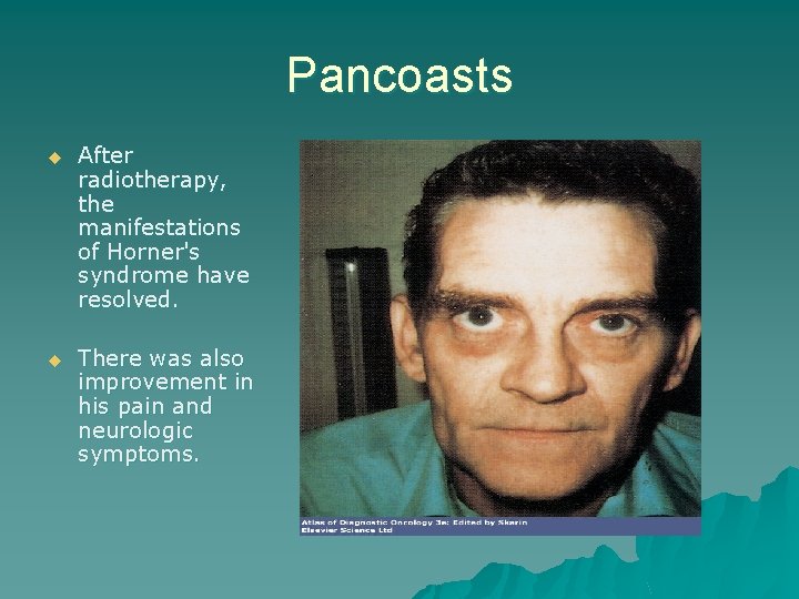 Pancoasts u After radiotherapy, the manifestations of Horner's syndrome have resolved. u There was