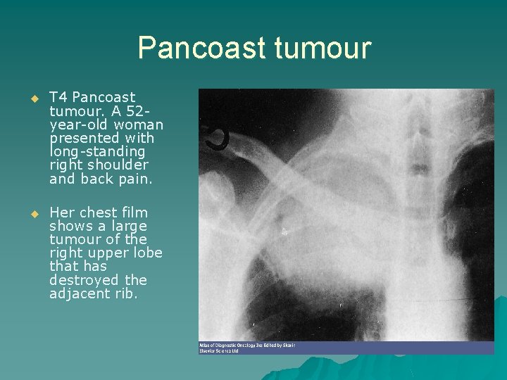 Pancoast tumour u T 4 Pancoast tumour. A 52 year-old woman presented with long-standing