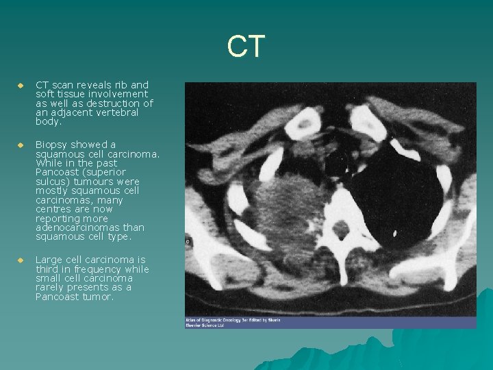 CT u CT scan reveals rib and soft tissue involvement as well as destruction