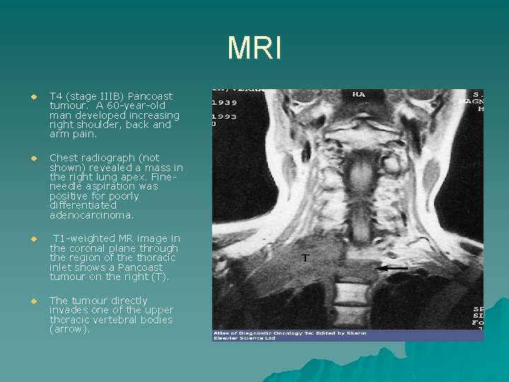 MRI u T 4 (stage IIIB) Pancoast tumour. A 60 -year-old man developed increasing