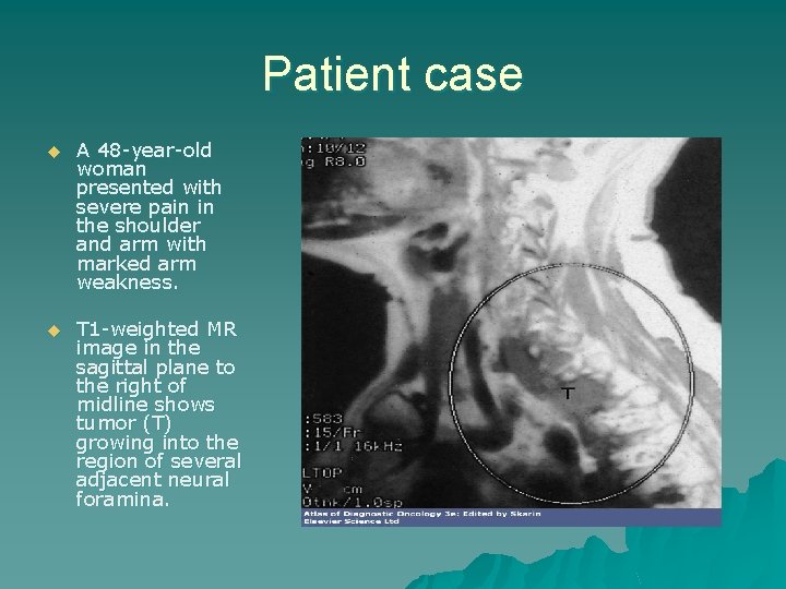 Patient case u A 48 -year-old woman presented with severe pain in the shoulder