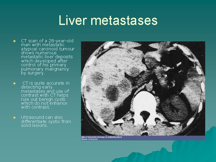 Liver metastases u CT scan of a 28 -year-old man with metastatic atypical carcinoid