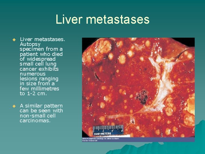 Liver metastases u Liver metastases. Autopsy specimen from a patient who died of widespread