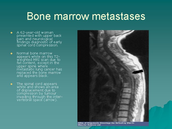 Bone marrow metastases u A 62 -year-old woman presented with upper back pain and