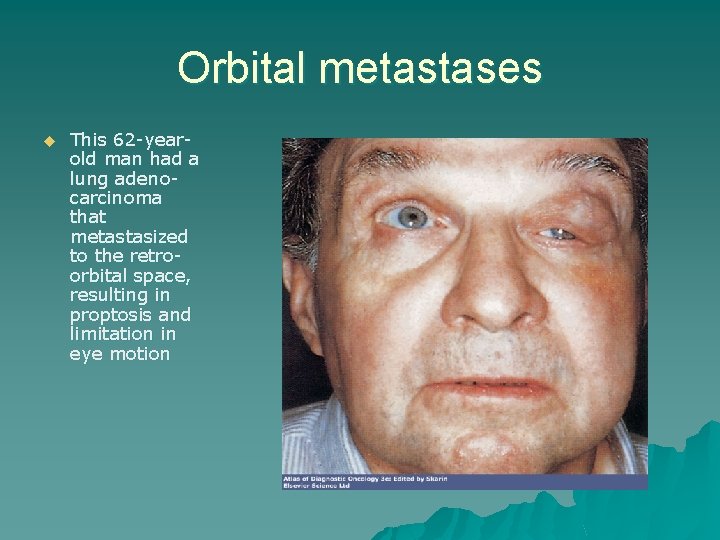 Orbital metastases u This 62 -yearold man had a lung adenocarcinoma that metastasized to