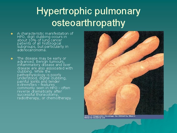 Hypertrophic pulmonary osteoarthropathy u A characteristic manifestation of HPO, digit clubbing occurs in about