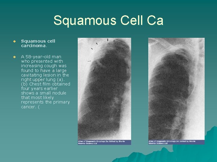 Squamous Cell Ca u Squamous cell carcinoma. u A 58 -year-old man who presented