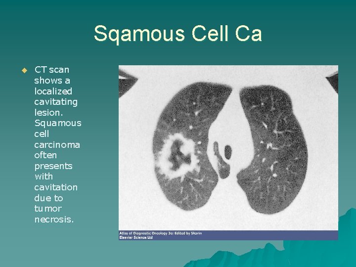 Sqamous Cell Ca u CT scan shows a localized cavitating lesion. Squamous cell carcinoma