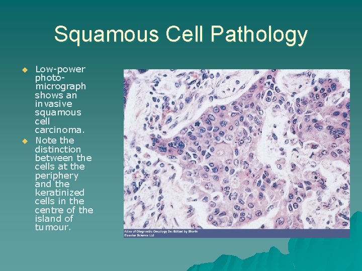 Squamous Cell Pathology u u Low-power photomicrograph shows an invasive squamous cell carcinoma. Note