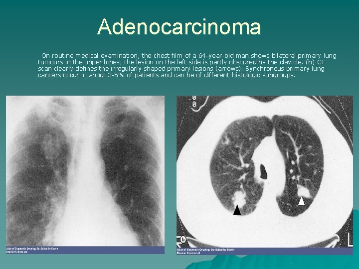 Adenocarcinoma On routine medical examination, the chest film of a 64 -year-old man shows