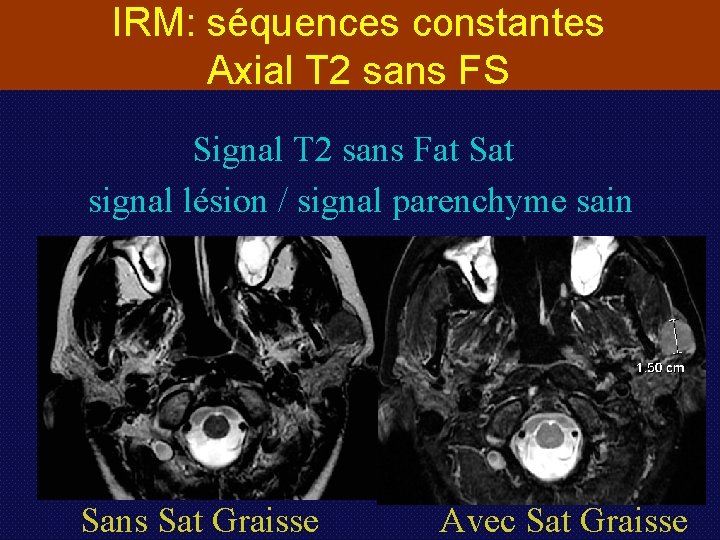 IRM: séquences constantes Axial T 2 sans FS Signal T 2 sans Fat Sat