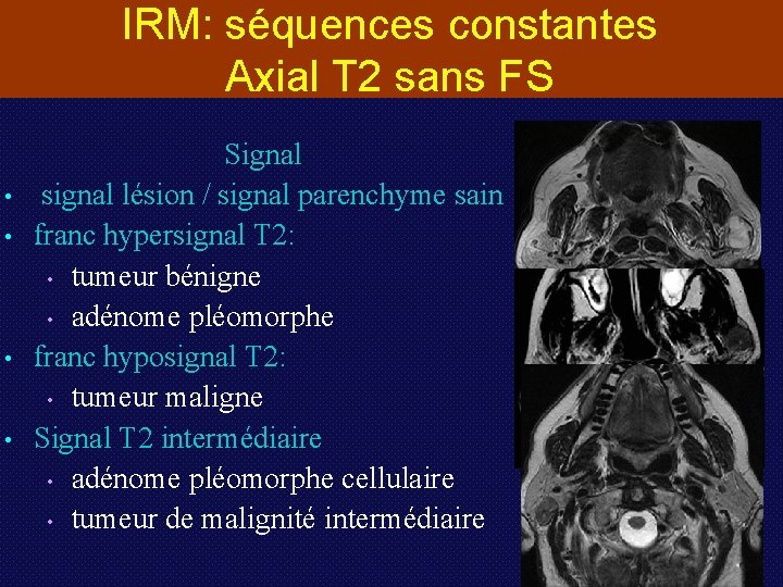 IRM: séquences constantes Axial T 2 sans FS • • Signal signal lésion /