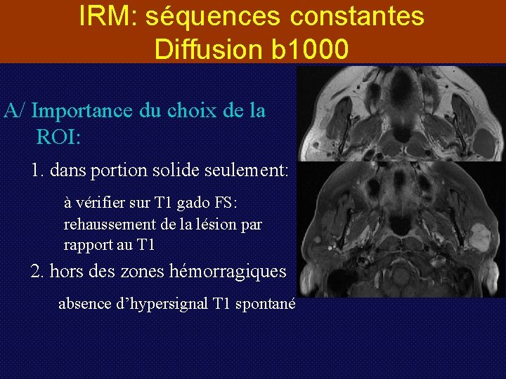 IRM: séquences constantes Diffusion b 1000 A/ Importance du choix de la ROI: 1.