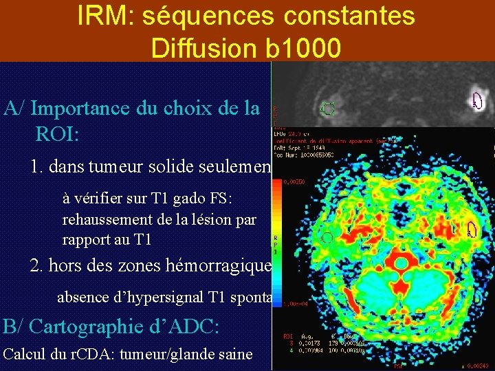 IRM: séquences constantes Diffusion b 1000 A/ Importance du choix de la ROI: 1.