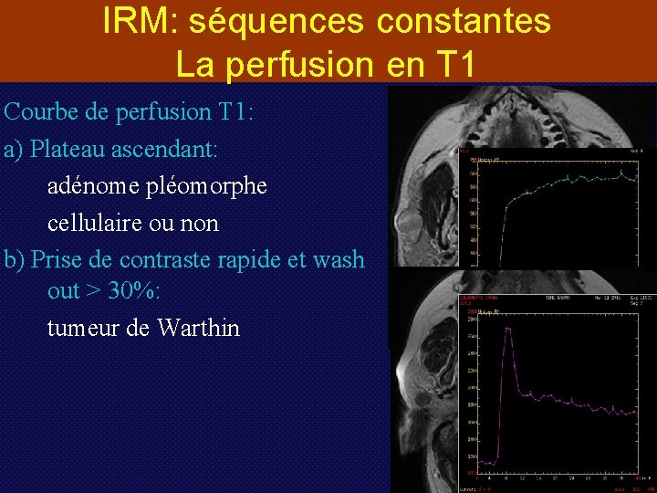 IRM: séquences constantes La perfusion en T 1 Courbe de perfusion T 1: a)