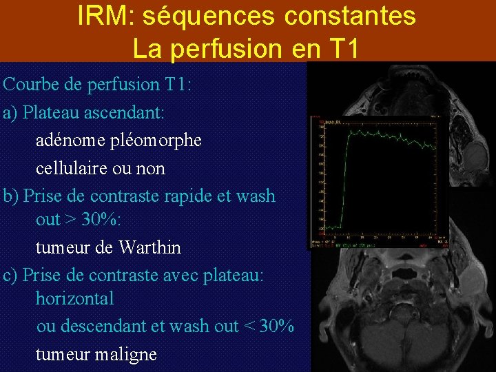 IRM: séquences constantes La perfusion en T 1 Courbe de perfusion T 1: a)