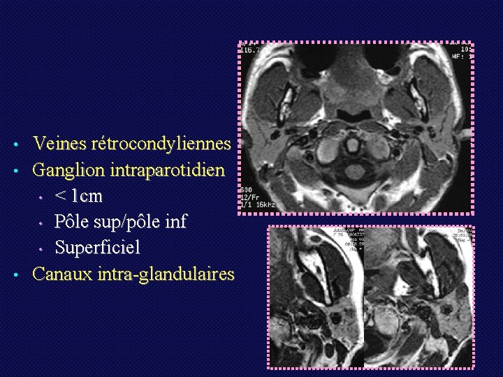  • • • Veines rétrocondyliennes Ganglion intraparotidien • < 1 cm • Pôle