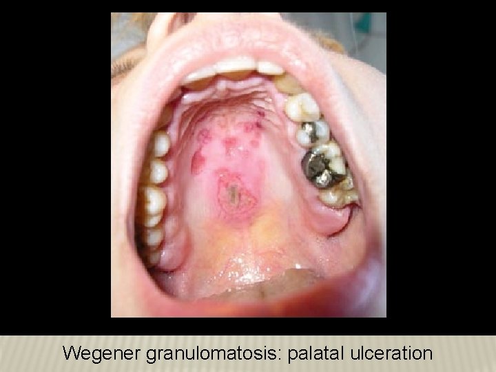Wegener granulomatosis: palatal ulceration Wegener granulomatosis: palatal ulceration