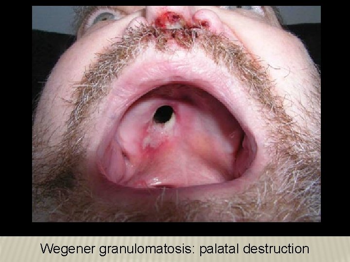 Wegener granulomatosis: palatal destruction Wegener granulomatosis: palatal destruction