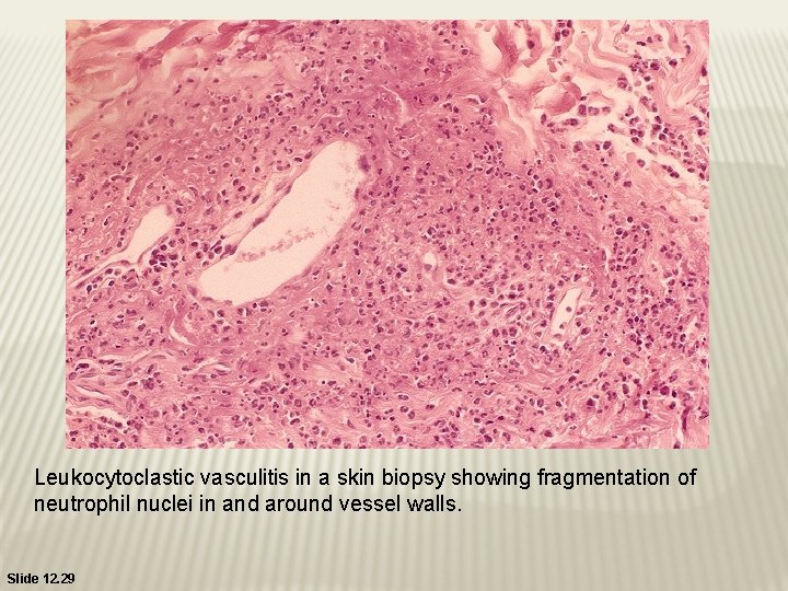 Leukocytoclastic vasculitis in a skin biopsy showing fragmentation of neutrophil nuclei in and around Leukocytoclastic vasculitis in a skin biopsy showing fragmentation of neutrophil nuclei in and around