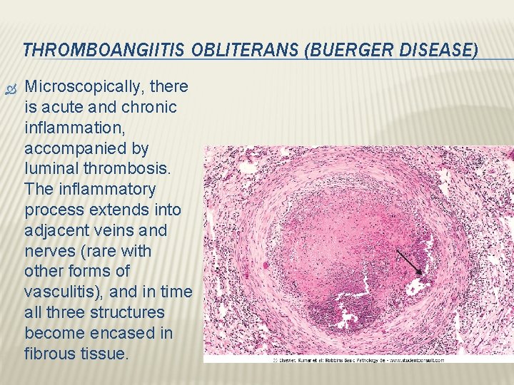THROMBOANGIITIS OBLITERANS (BUERGER DISEASE) Microscopically, there is acute and chronic inflammation, accompanied by luminal THROMBOANGIITIS OBLITERANS (BUERGER DISEASE) Microscopically, there is acute and chronic inflammation, accompanied by luminal