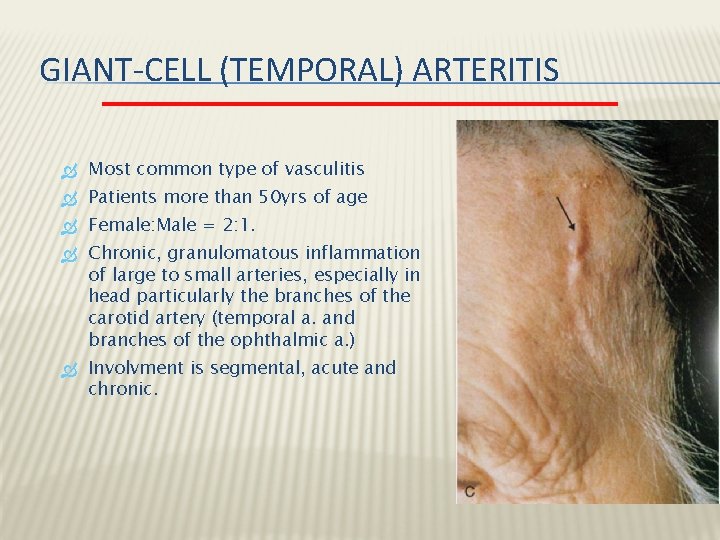 GIANT-CELL (TEMPORAL) ARTERITIS Most common type of vasculitis Patients more than 50 yrs of GIANT-CELL (TEMPORAL) ARTERITIS Most common type of vasculitis Patients more than 50 yrs of