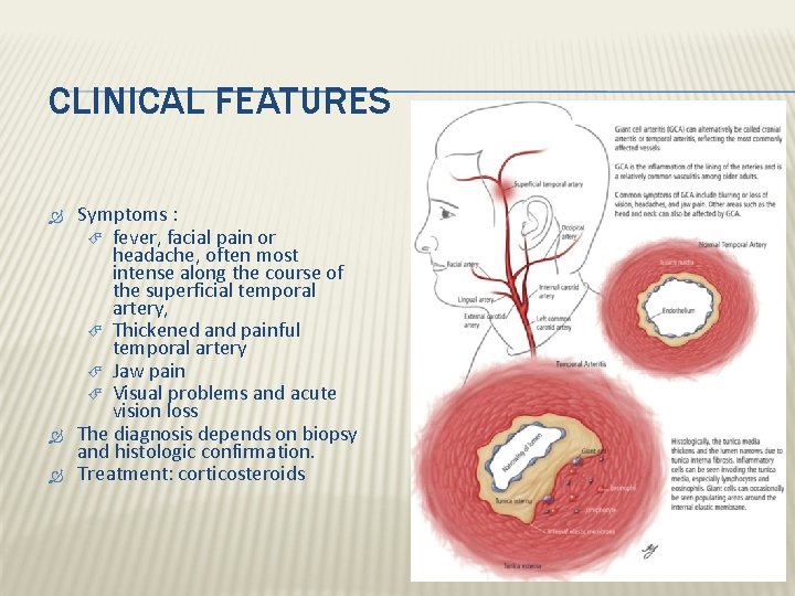 CLINICAL FEATURES Symptoms : fever, facial pain or headache, often most intense along the CLINICAL FEATURES Symptoms : fever, facial pain or headache, often most intense along the