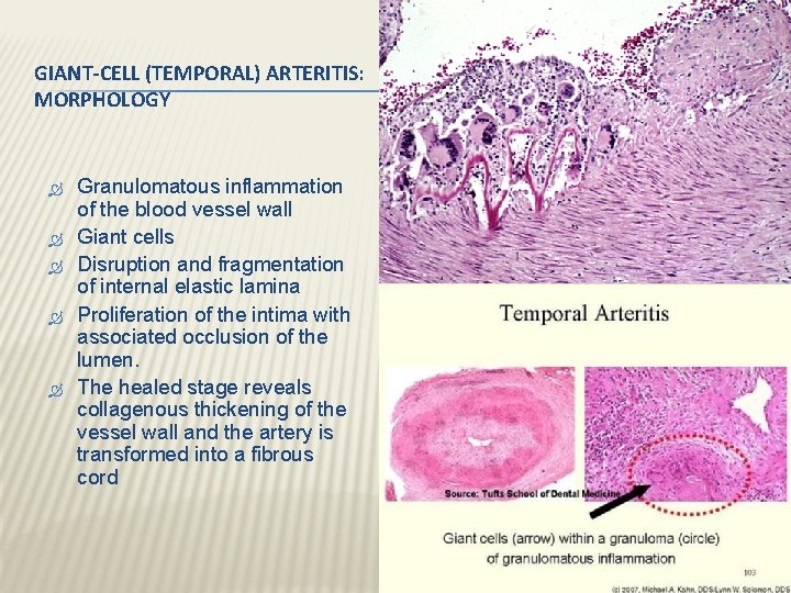 GIANT-CELL (TEMPORAL) ARTERITIS: MORPHOLOGY Granulomatous inflammation of the blood vessel wall Giant cells Disruption GIANT-CELL (TEMPORAL) ARTERITIS: MORPHOLOGY Granulomatous inflammation of the blood vessel wall Giant cells Disruption