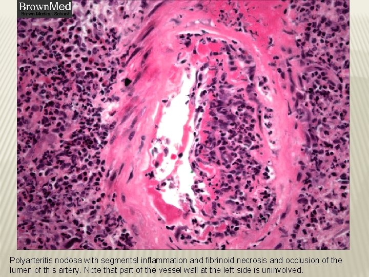 Polyarteritis nodosa with segmental inflammation and fibrinoid necrosis and occlusion of the lumen of Polyarteritis nodosa with segmental inflammation and fibrinoid necrosis and occlusion of the lumen of