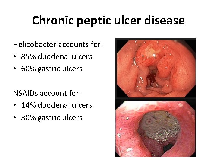 Chronic peptic ulcer disease Helicobacter accounts for: • 85% duodenal ulcers • 60% gastric Chronic peptic ulcer disease Helicobacter accounts for: • 85% duodenal ulcers • 60% gastric