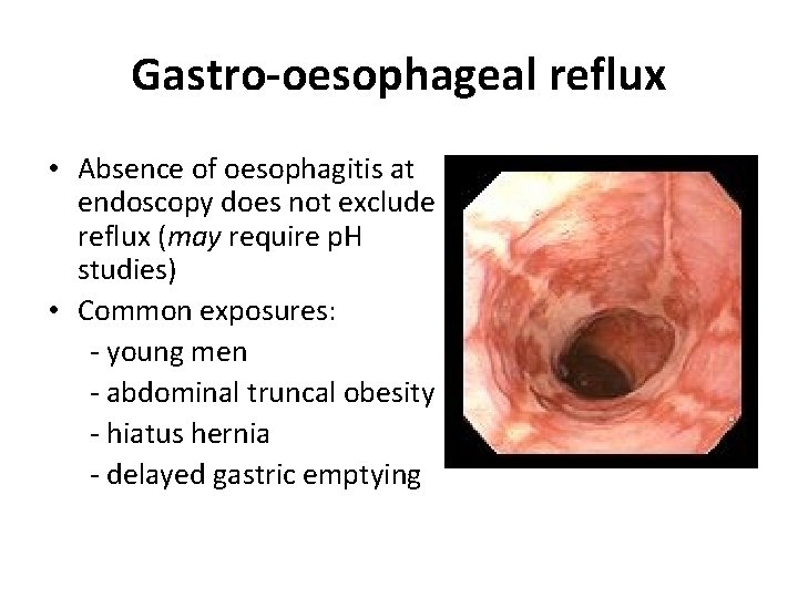 Gastro-oesophageal reflux • Absence of oesophagitis at endoscopy does not exclude reflux (may require Gastro-oesophageal reflux • Absence of oesophagitis at endoscopy does not exclude reflux (may require