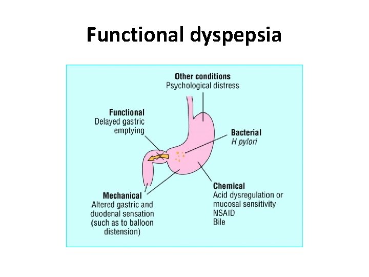 Functional dyspepsia Functional dyspepsia